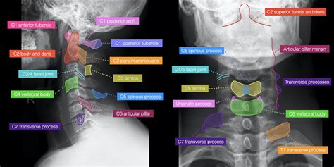 Cervical Spine Xray Anatomy Ap And Lateral Grepmed