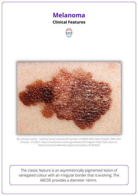 Melanoma - GlennKaniece