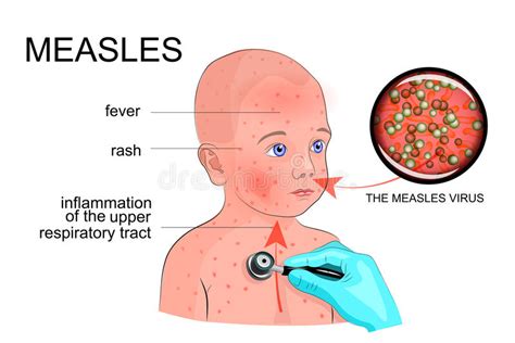 Measles Mumps Mmr Vaccine With Needle Stock Image Image Of Bottle