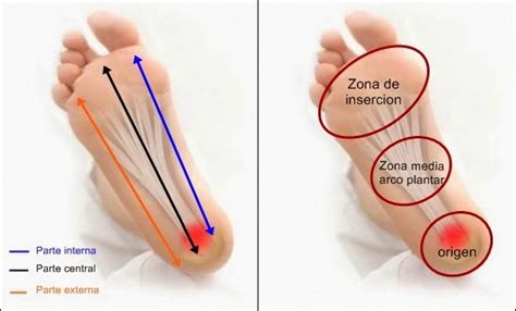 La fascitis plantar o inflamación de la parte baja del pie genera problemas para caminar. Fascitis Plantar