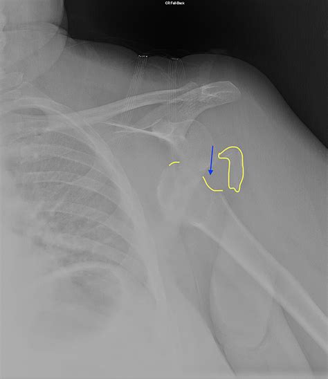 Cureus Anterior Shoulder Dislocation Complicated By Hill Sachs Lesion