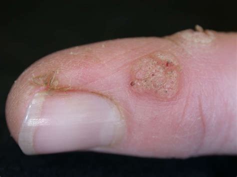 Periungual Warts Pictures Treatment And Prevention