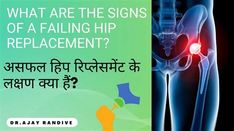 What Are The Signs Of A Failing Hip Replacement Dr Randives Super