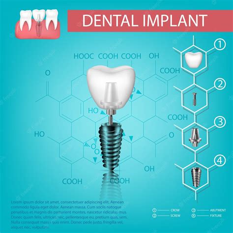 Diente Realista Vectorial Elementos Estructurales De Un Implante Dental