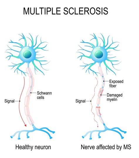 Multiple Sclerosis Wellness Guru Australia