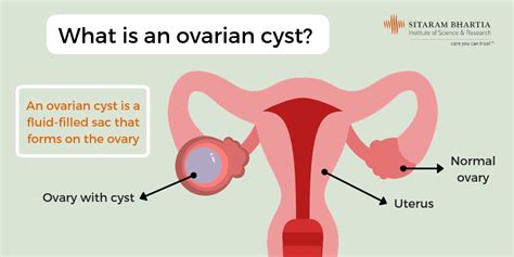 Ovary Cyst Burst