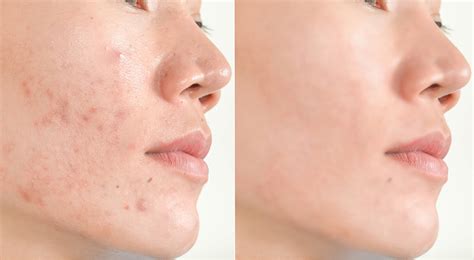 Chemical Peels For Acne Scars The New Jersey Vein And Vascular Center