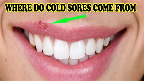 How To Get Rid Of Cold Sores In Your Mouth Youtube