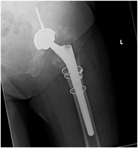 Extended Trochanteric Osteotomy Improving The Access And Reducing The