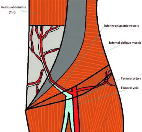 Anatomy Of The Inferior Epigastric Vessels Identified A Weak Point