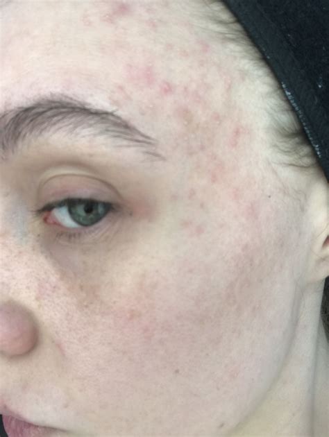 Help 25 Started Getting Clusters Of Pimples Around My Temple Area In