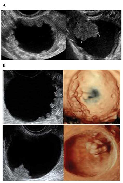 Ovarian Serous Borderline Tumors A Papillary Projection With
