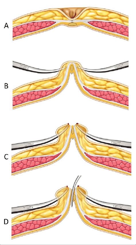 A Horizontal View Of The Umbilicus B Inverted Umbilicus Using