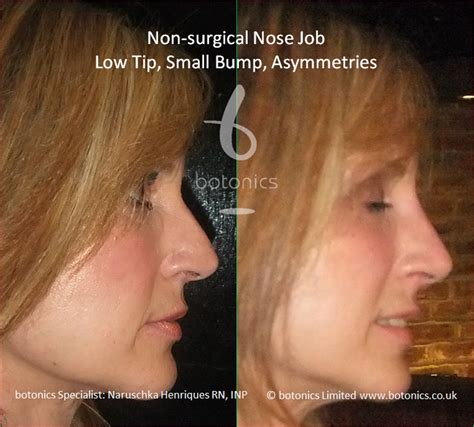 Check spelling or type a new query. Non-surgical Nose Job Before and After Pictures - botonics