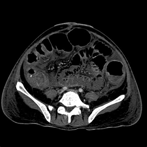Fulminant Clostridium Difficile Colitis Gut