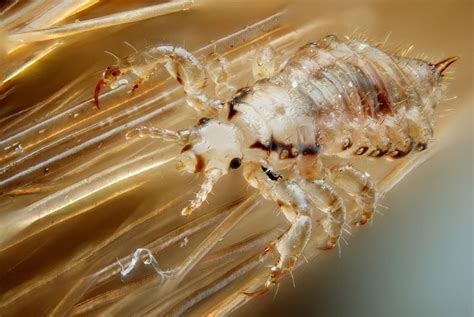 Infested: Dealing with head lice – Now Look Here!