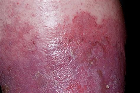 How well do cellulite fixes work? Test your knowledge of cellulitis | Chemist+Druggist