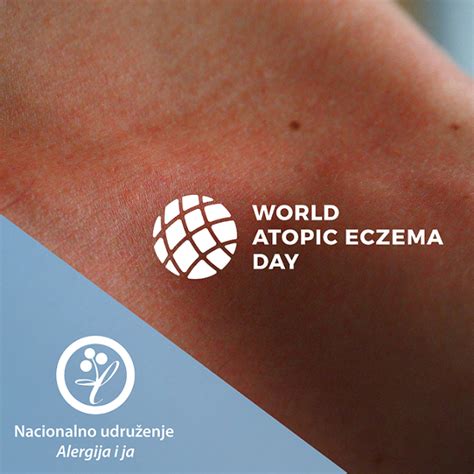 U susret Međunarodnom danu atopijskog ekcema u Beogradu Alergija i ja