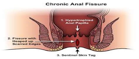 It causes distressing because of foul odor and soiling with recurrent infection and discharge. Ayurvedic treatment, Piles/Hemorrhoids, Anal fissure ...