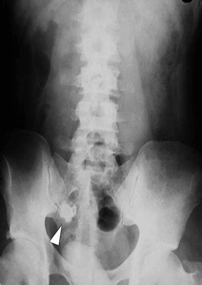 Abc Radiology Blog Appendicitis