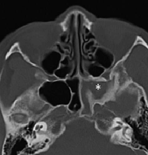 Fifty Eight Year Old Woman With Chronic Fungal Sphenoid Sinusitis
