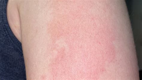 Notice A Strange Rash Days After Getting The Covid 19 Vaccine Experts