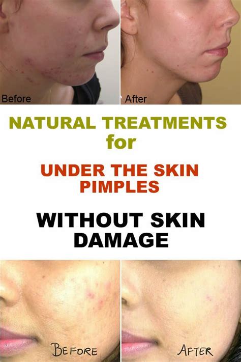 Under The Skin Pimples Remedies Without Skin Damage Diva Secrets