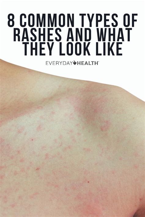 Common Types Of Rashes Everyday Health In Types Of Rashes Porn Sex Picture