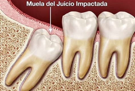 Muelas Del Juicio Y Sus Problemas Más Frecuentes Clínica Dental Nadal