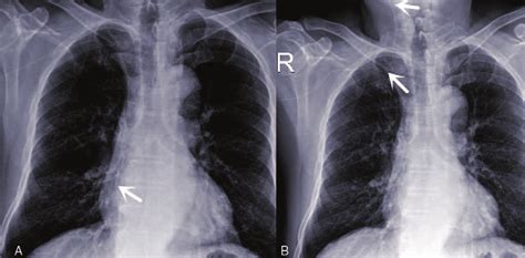 A Chest X Ray Demonstrating Picc Tip Located In Lower One Third Of