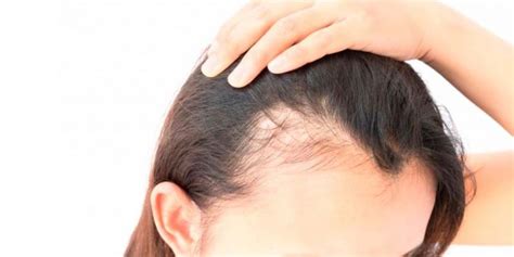 Alopecia AndrogÉnica Clínica De Medicina Estética Dra Anna Roca