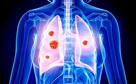 The most common types of lung cancer are those found right in the lungs. Non-small cell lung cancer: women live longer than men
