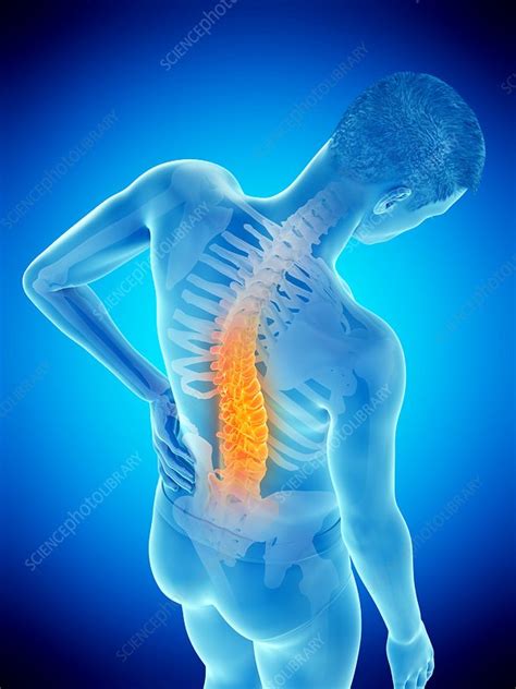 Back Pain Conceptual Illustration Stock Image F0258027 Science