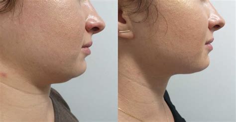 Kybella Review And Before And After Pictures Shape