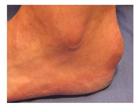 Blackmer Foot And Ankle Haglunds Deformity In Meridian