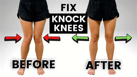 Knock Knees Causes Treatment And Best Exercises 2023