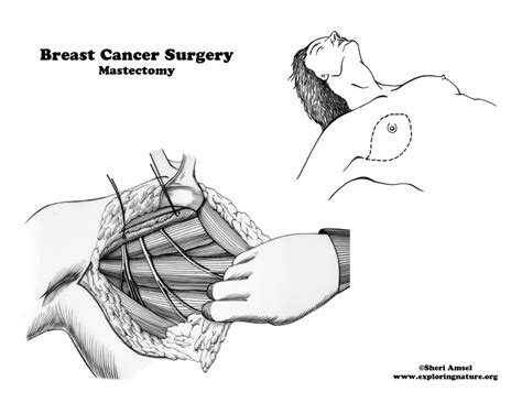 Breast Cancer Surgery Mastectomy