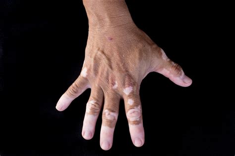 Weißfleckenkrankheit Vitiligo Ursachen Und Behandlung Heilpraxis
