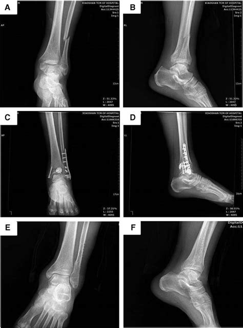 Male Years Old Left Ankle Fracture Caused By Sprain Type B Of Download Scientific Diagram