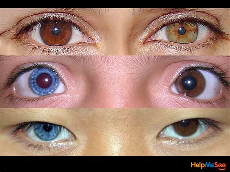 The Condition Where Someone Is Born With Two Different Colored Eyes Is