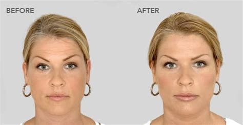 Cure For Sunken Cheeks And Hollowed Eyes Dr Mekelburg