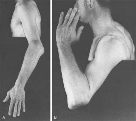 Physical Examination Of The Elbow Musculoskeletal Key