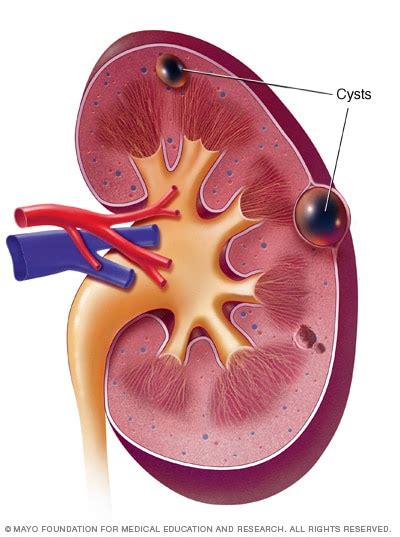 Kidney Cysts Symptoms And Causes Mayo Clinic