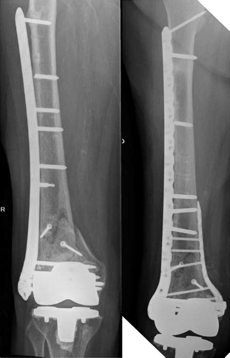 Treatment Of B1 Distal Periprosthetic Femur Fractures Orthopedic Clinics