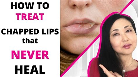 How To Treat Chapped Lips That Never Heal Actinic Cheilitis 4 Grades