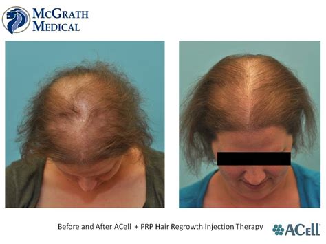 acell prp hair regrowth injection therapy austin houston and dallas texas