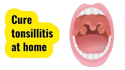 Effective Tonsillitis Home Remedies Easy To Use Youtube