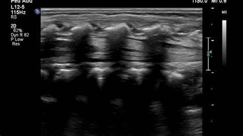 Spinal Ultrasound Normal Sagittal Anatomy Youtube
