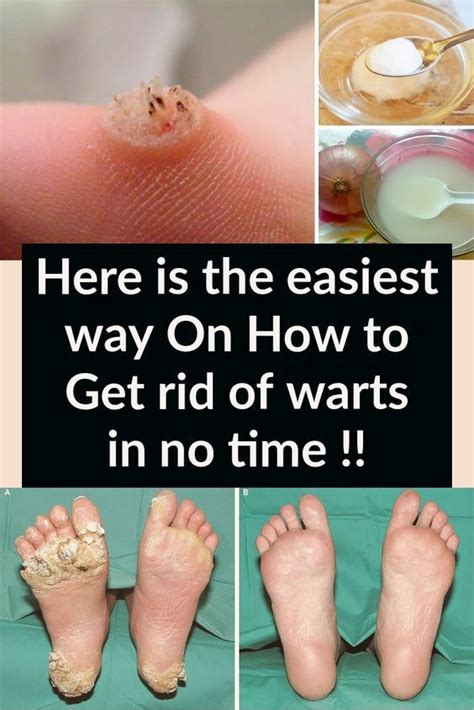 Here Is The Easiest Way On How To Get Rid Of Warts In No Time Tips