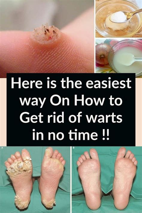 They may have tiny black or dark dots which are clotted blood vessels, and not the actual wart seed. Here is the easiest way On How to Get rid of warts in no ...